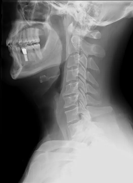 Radiografia del rachide cervicale in proiezione laterale - RX rachide cervicale a domicilio Roma