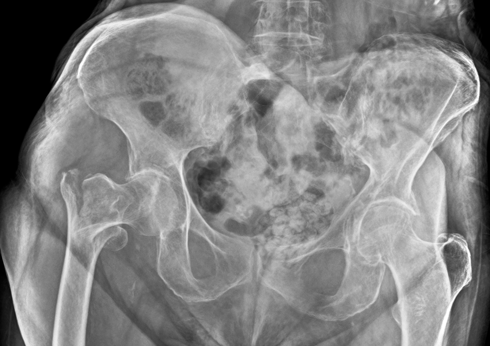 Radiografia del bacino con protesi d'anca eseguita a domicilio
