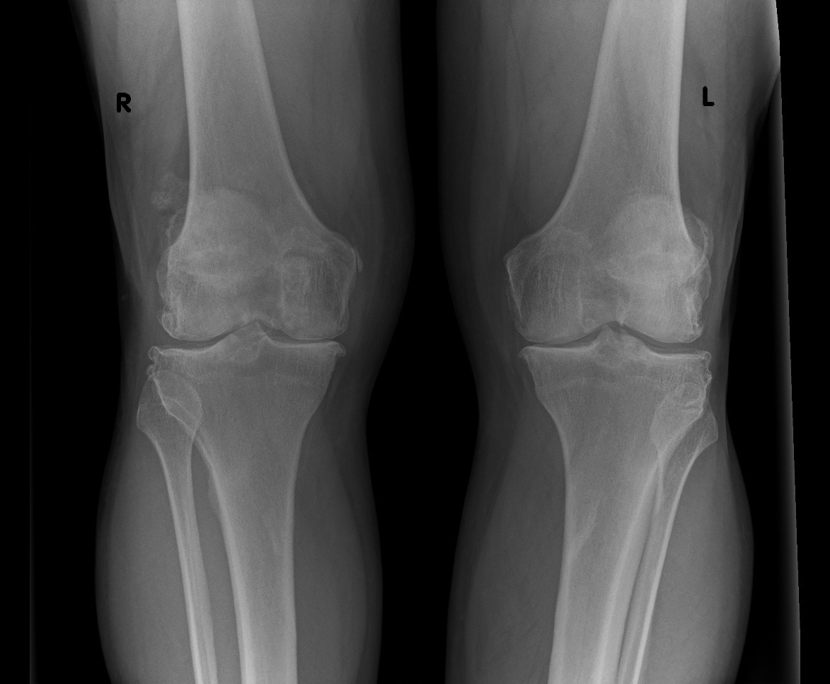 Radiografia delle due ginocchia in carico eseguita a domicilio