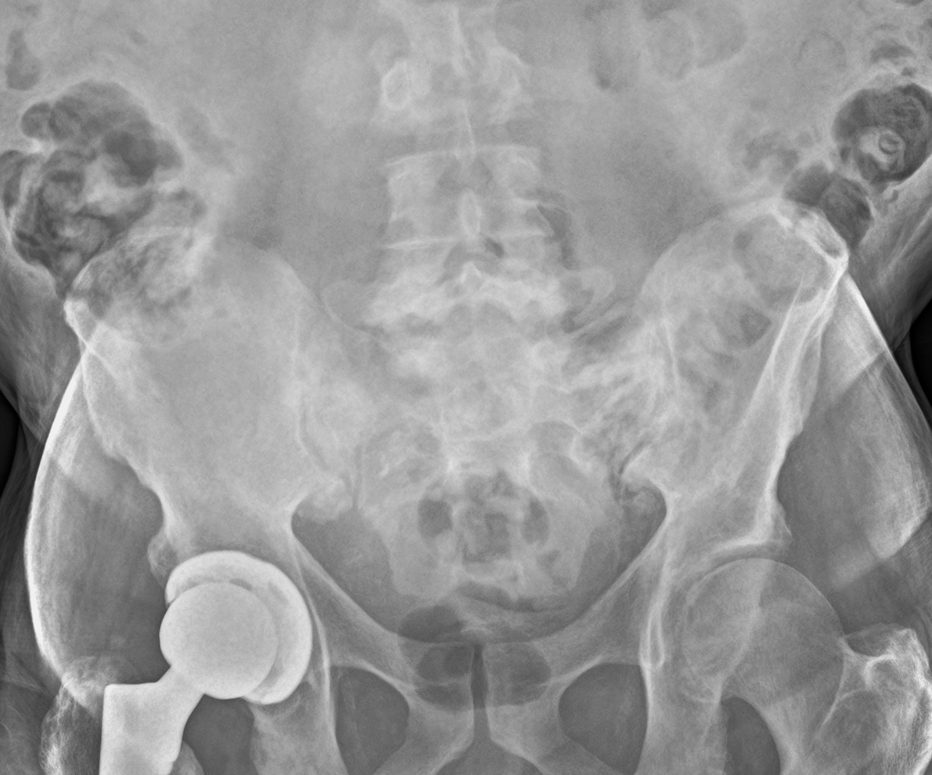 Radiografia del bacino con protesi all'anca destra eseguita a domicilio
