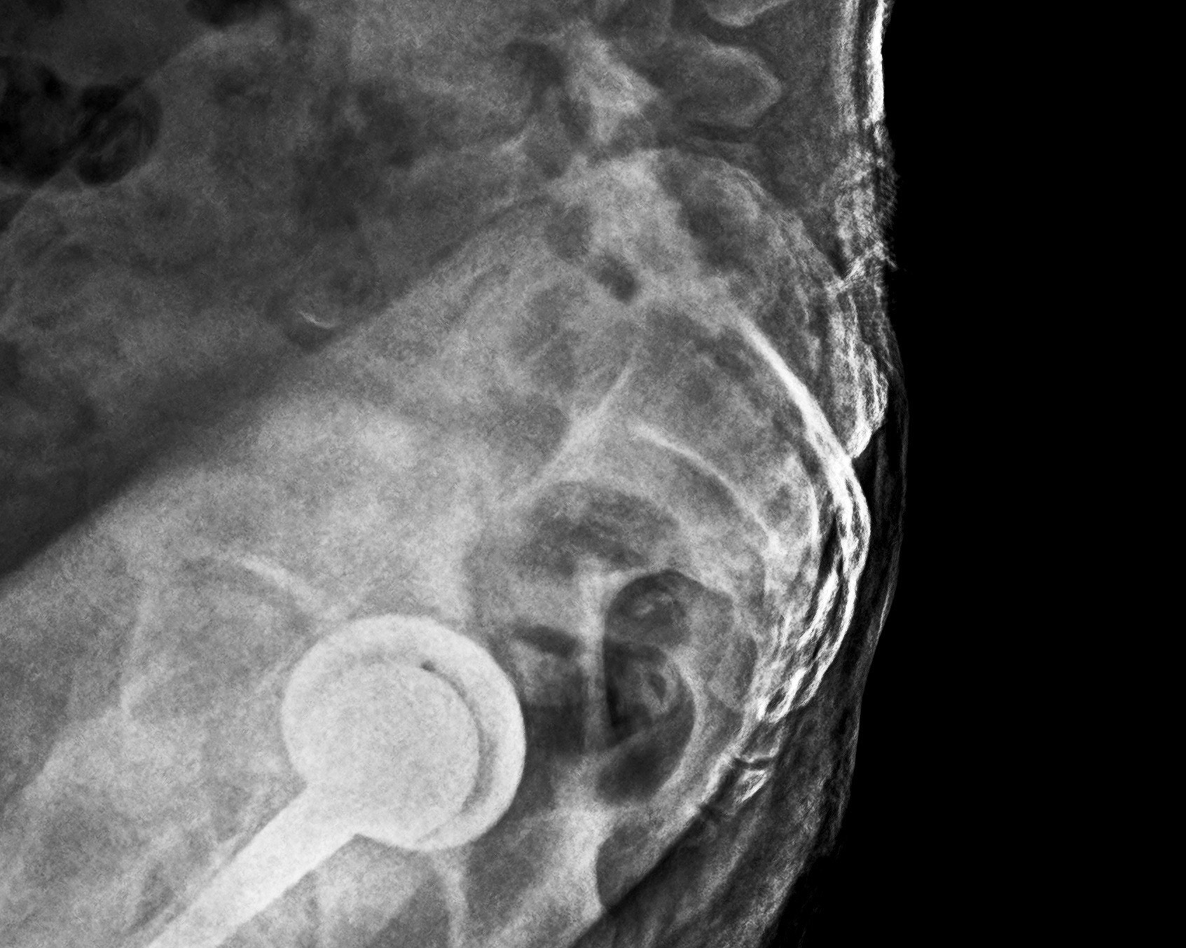 Radiografia laterale dell'anca con protesi eseguita a domicilio