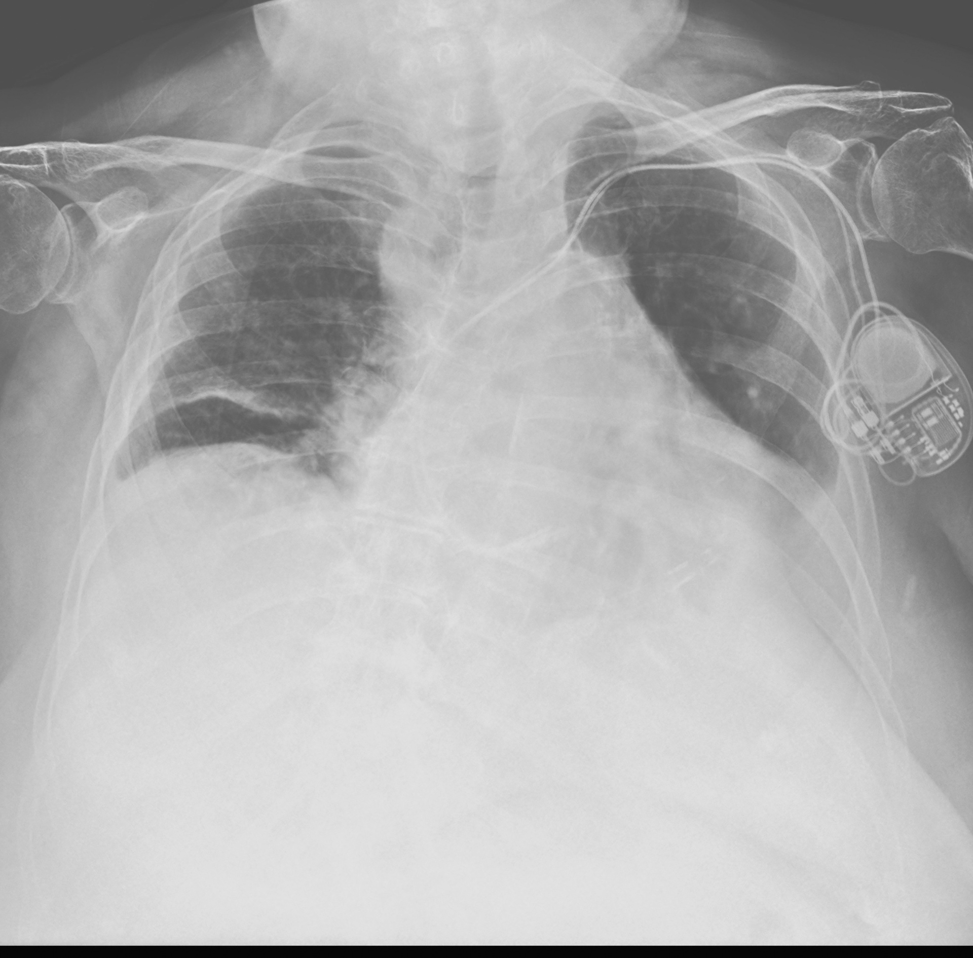 Radiografia del torace in un paziente portatore di pacemaker eseguita a domicilio