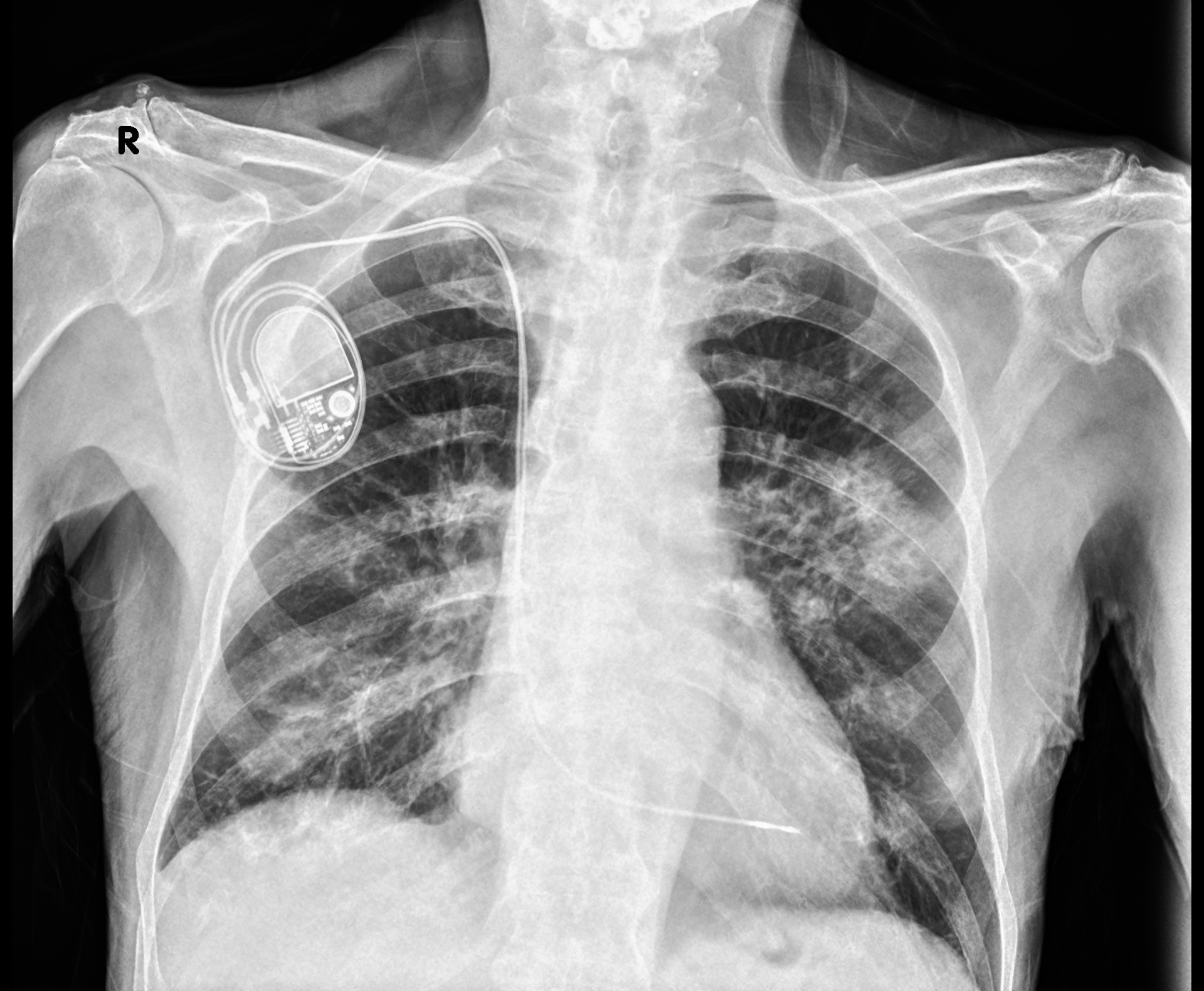 Radiografia del torace in un paziente portatore di pacemaker eseguita a domicilio