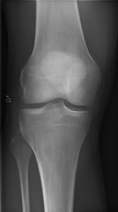 Radiografia del ginocchio in proiezione anteroposteriore - RX ginocchio a domicilio Roma