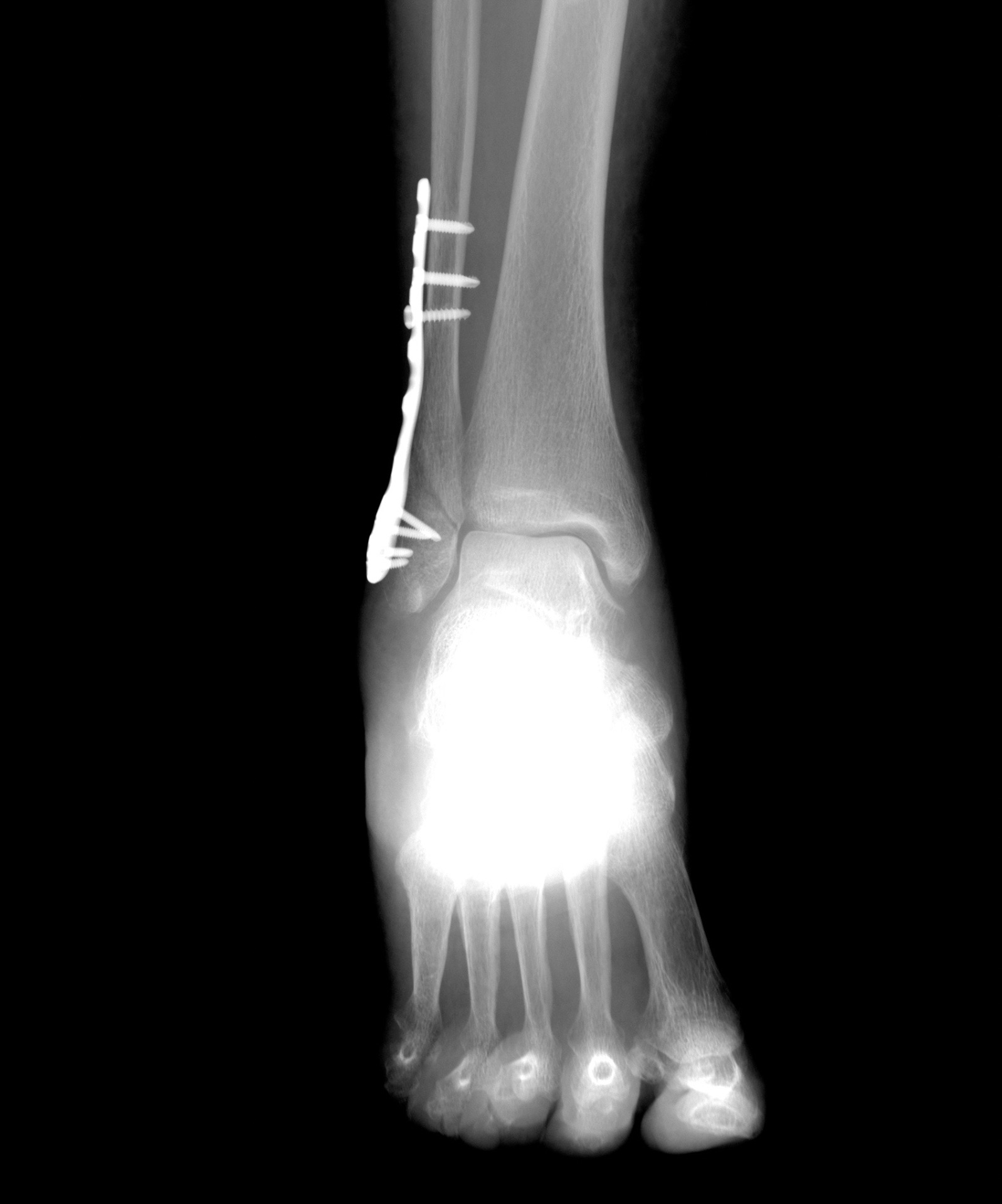 Radiografia della caviglia con placca e viti di sintesi eseguita a domicilio