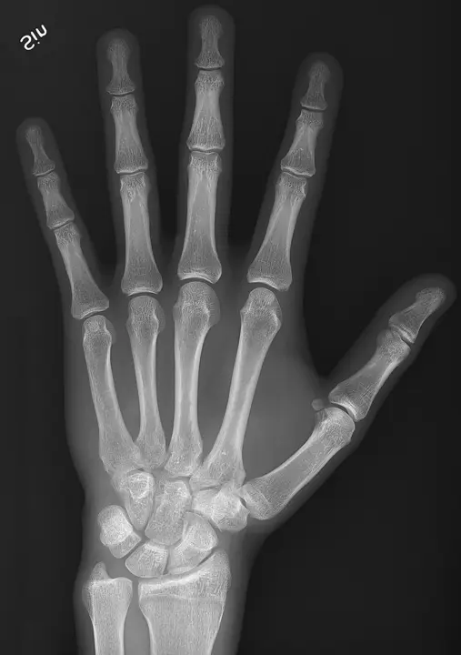 Radiografia della mano in proiezione dorsopalmare - RX mano a domicilio Roma