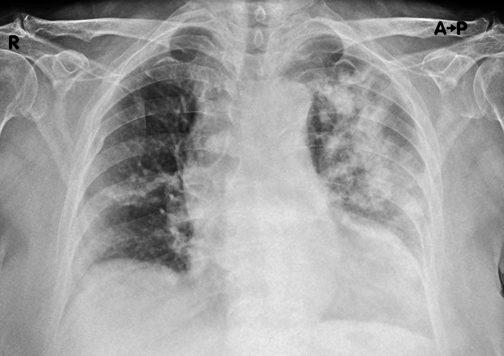 Radiografia del torace in proiezione antero-posteriore eseguita a domicilio