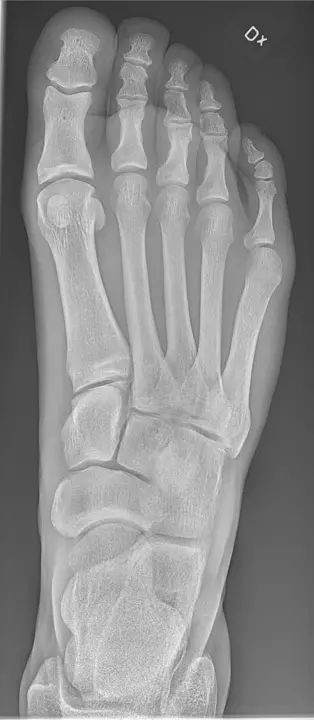 Radiografia del piede in proiezione dorsoplantare - RX piede a domicilio Roma