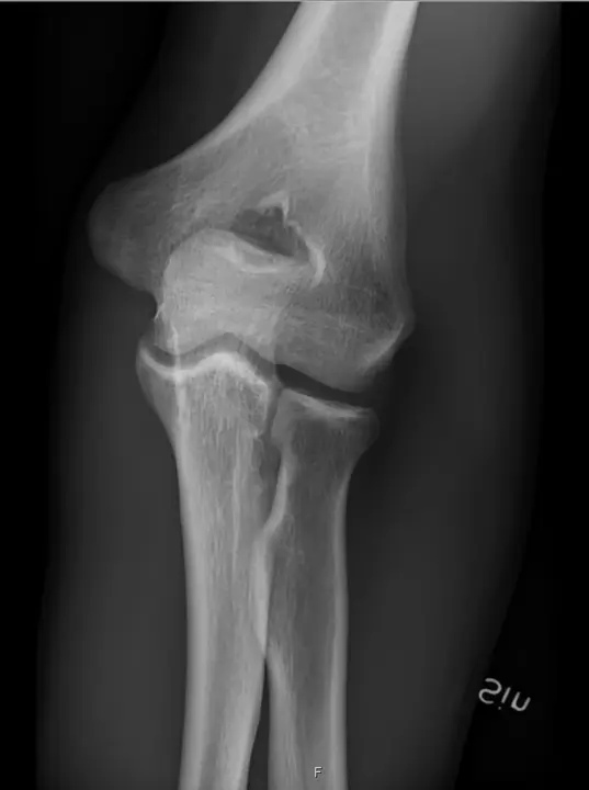 Radiografia del gomito in proiezione anteroposteriore - RX gomito a domicilio Roma