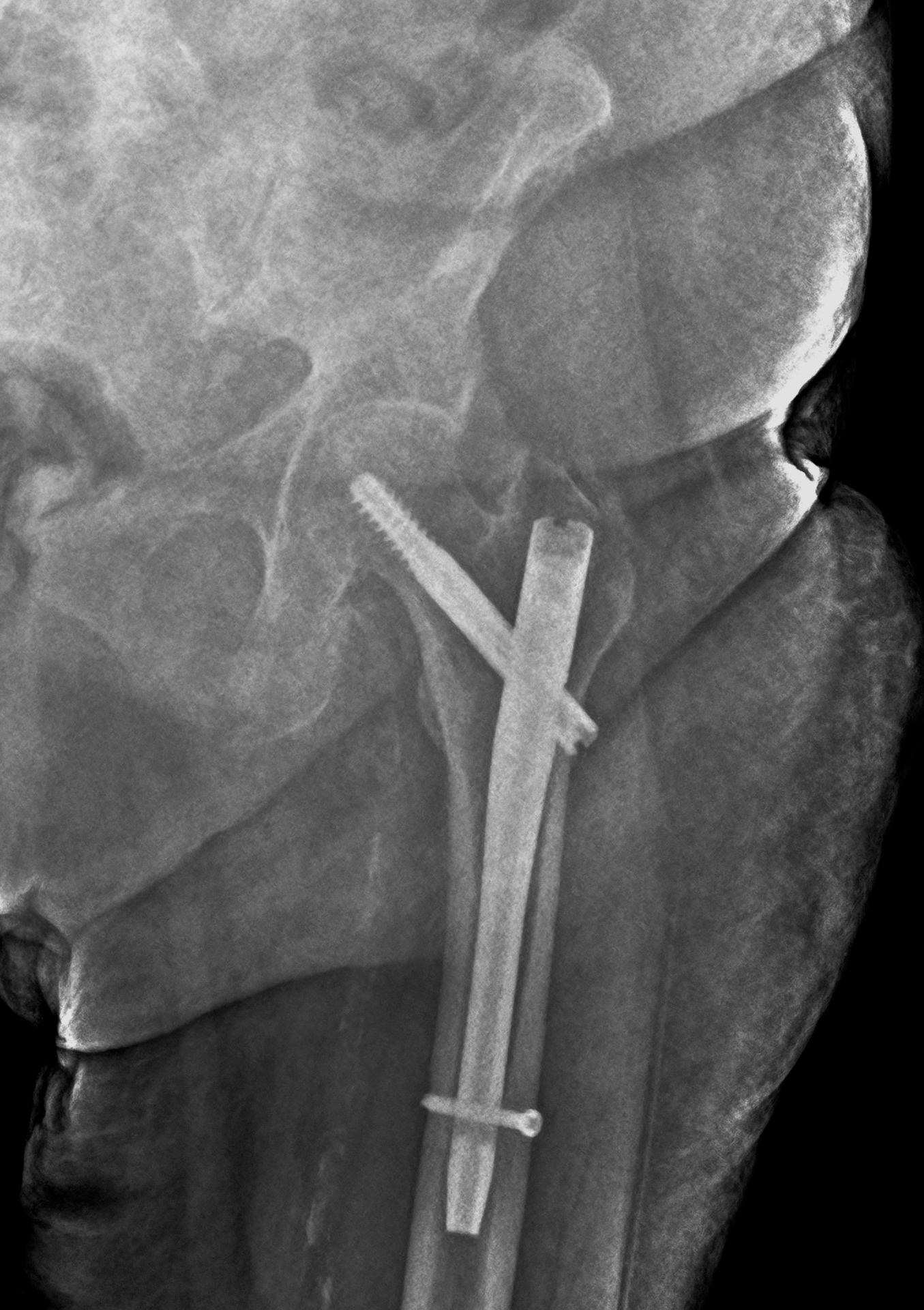 Radiografia del femore con chiodo endomidollare eseguita a domicilio