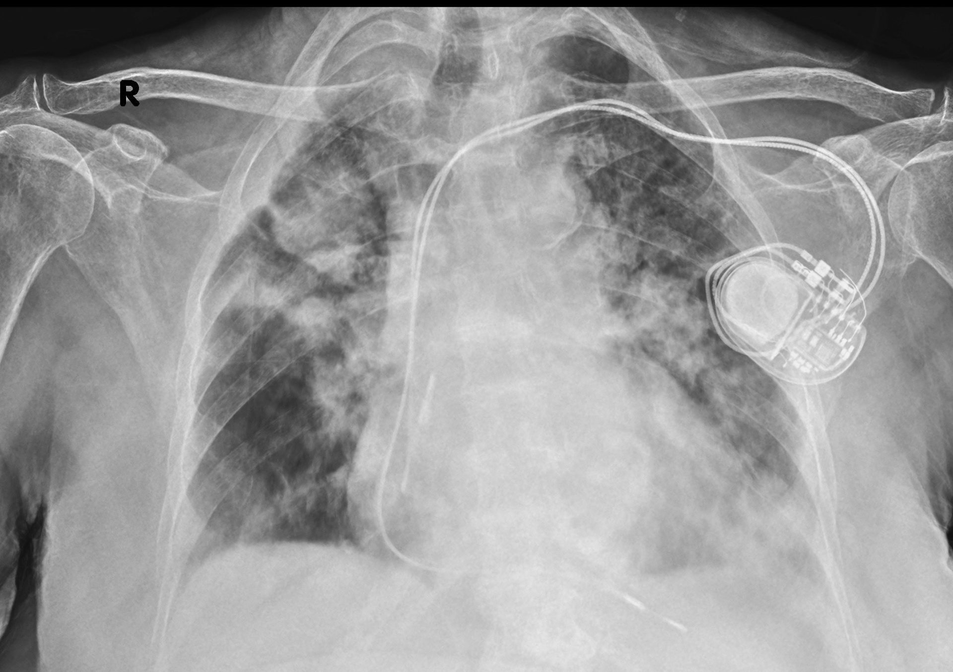 Radiografia del torace eseguita a domicilio in un paziente portatore di pacemaker