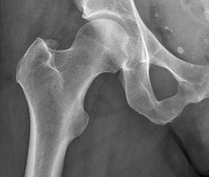 Radiografia dell'anca - RX anche a domicilio Roma