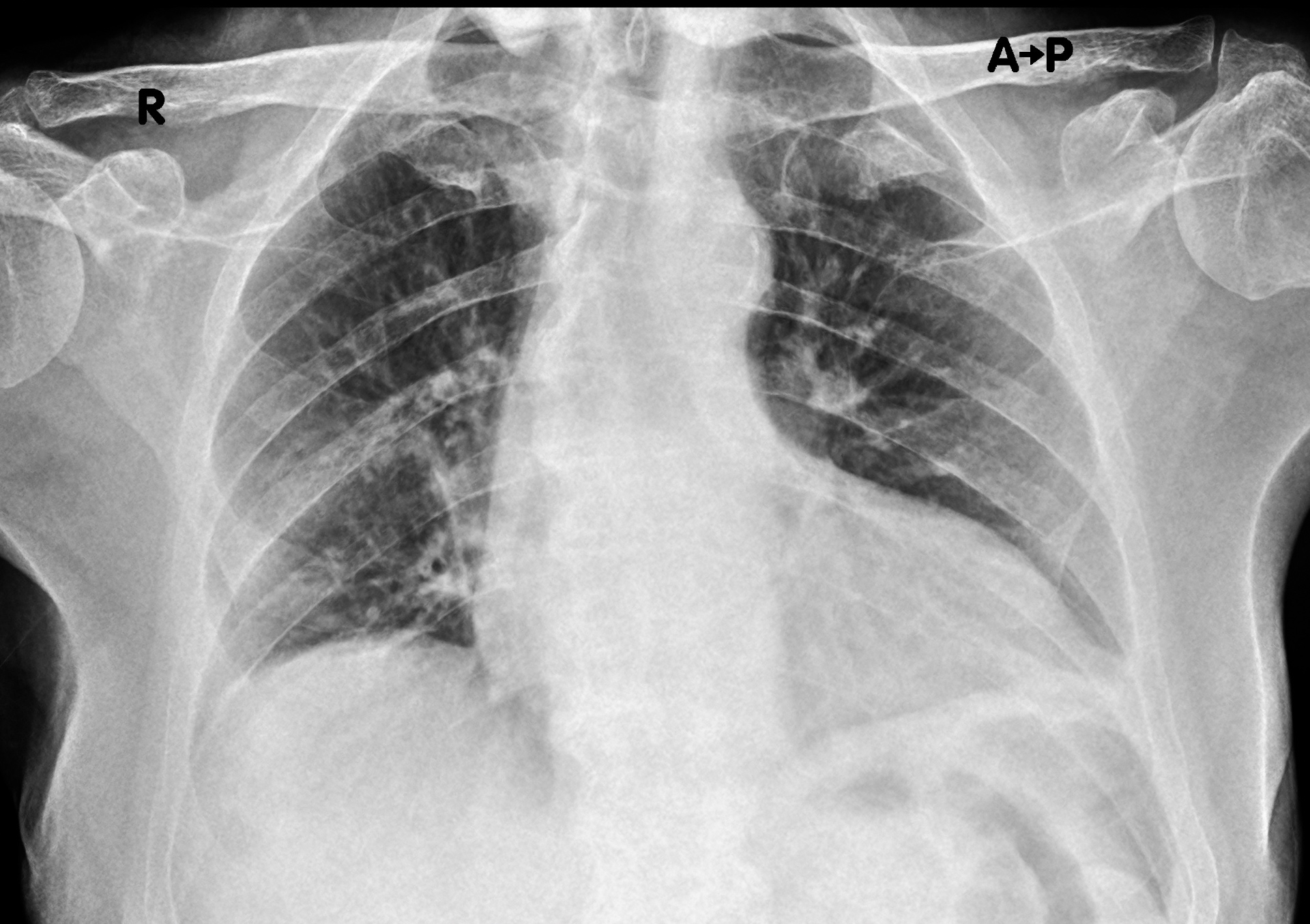Radiografia del torace in proiezione antero-posteriore eseguita a domicilio con apparecchio portatile