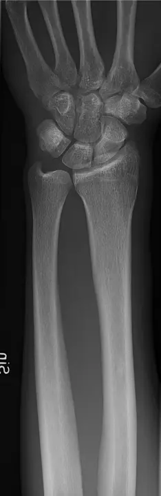 Radiografia del polso in proiezione dorsopalmare - RX polso a domicilio Roma